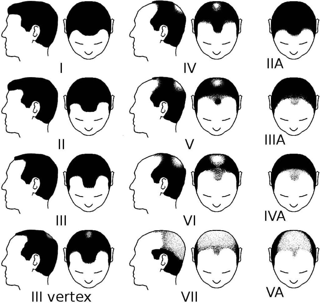 Norwood-scale-for-male-pattern-baldness