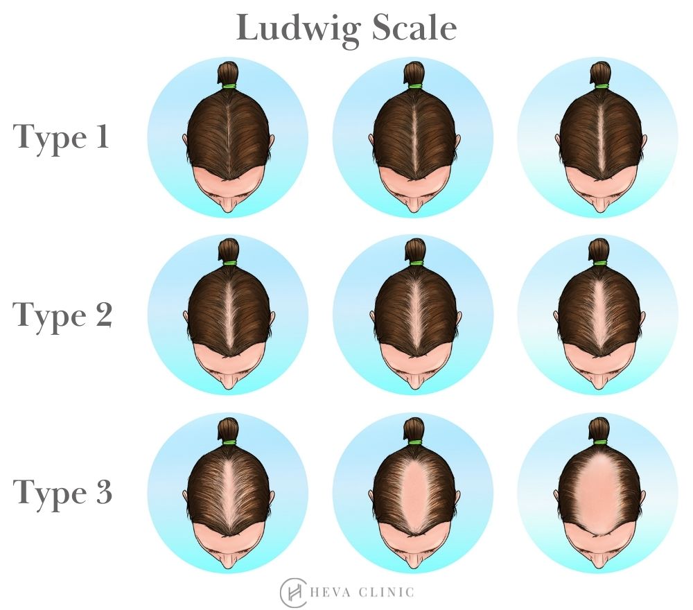 ludwig-scale-female-hair-loss-baldness-pattern