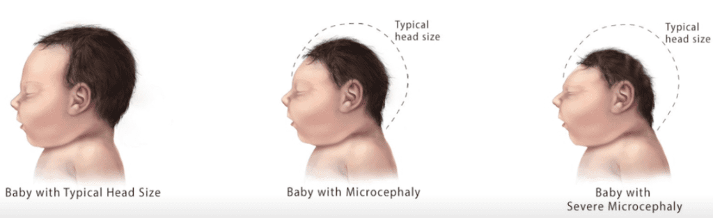 microcephaly